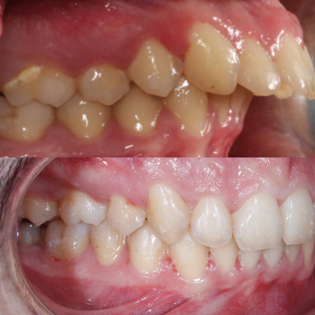 Antes e Depois