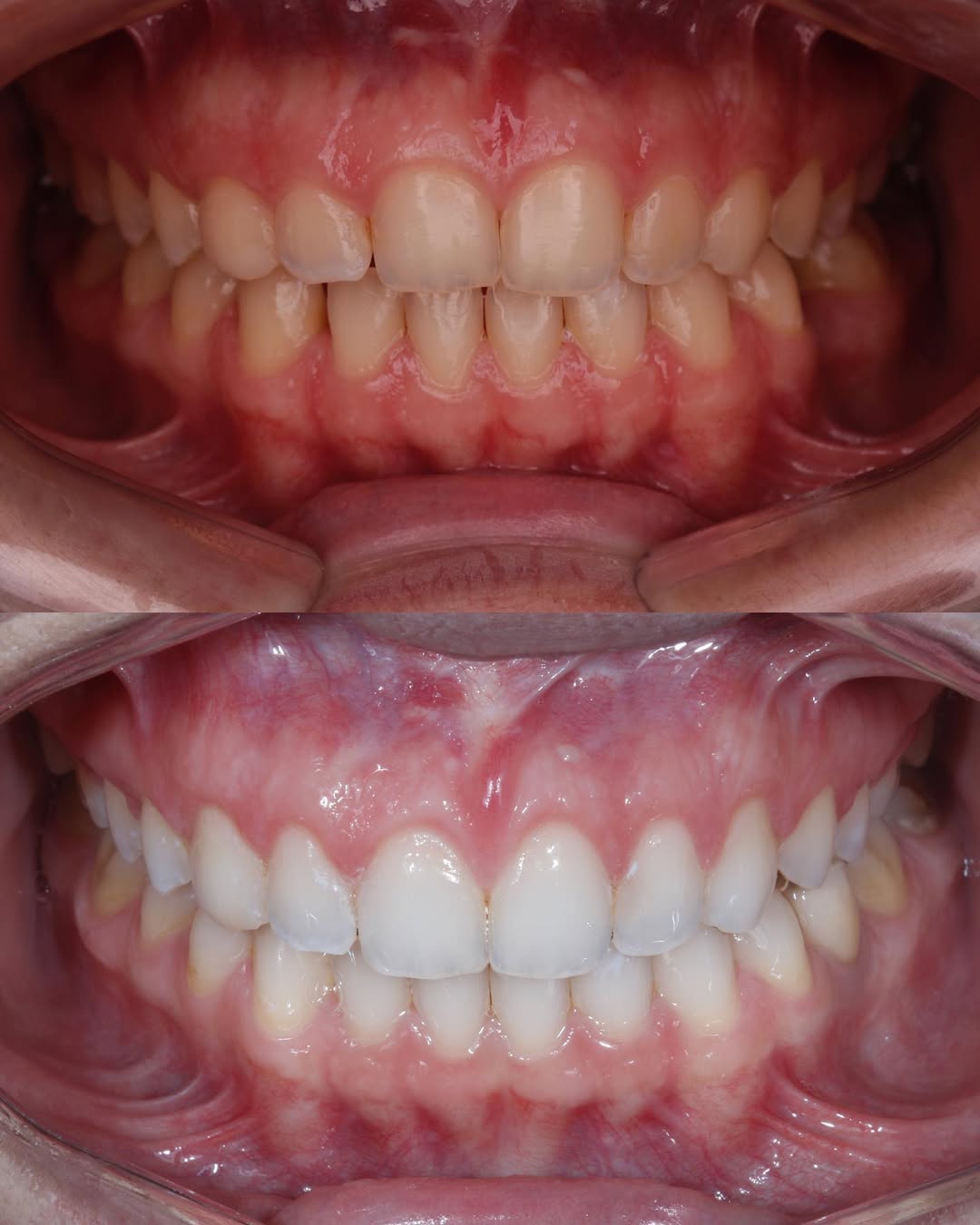 Antes e Depois